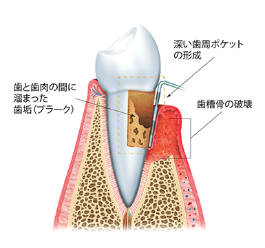 歯周病が進行すると？