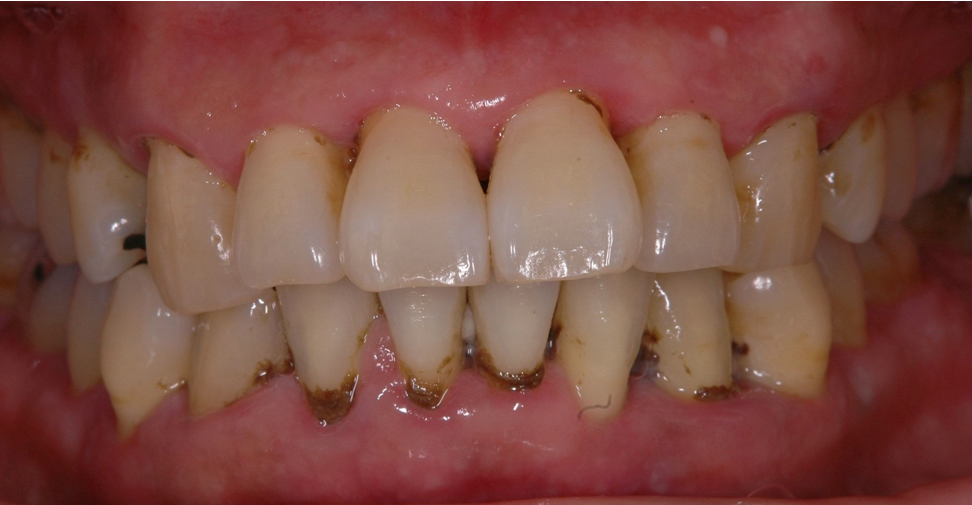 歯周病